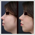 chin implants